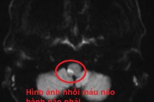 Đột quỵ não sau khi uống rượu, nguy kịch phải nhập viện
