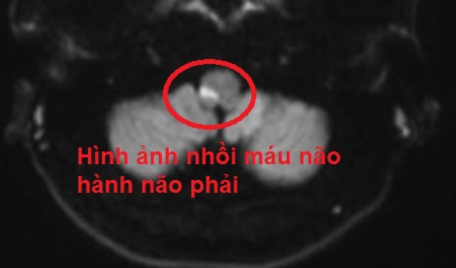 Đột quỵ não sau khi uống rượu, nguy kịch phải nhập viện