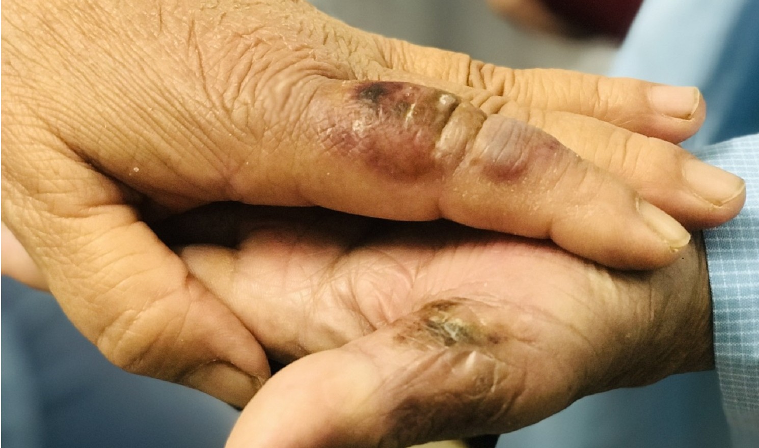 2 vợ chồng cùng nhập viện sau khi bị chuột cắn